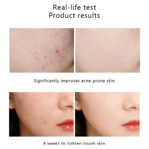 The Ordinary 30ml Serum | Niacinamide 10% + Zinc 1% for Clear, Balanced Skin