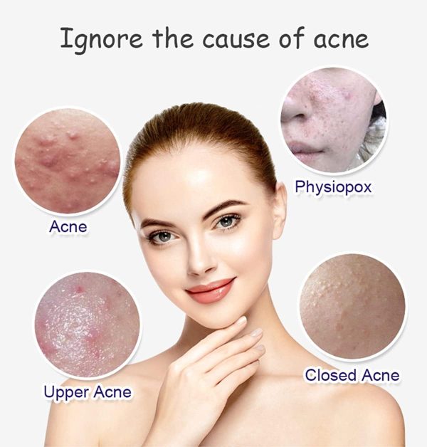 Aichun Beauty Whitening & Anti-Acne Serum | Aloe Vera & Salicylic Acid | 30ml Skin Brightening Formula
