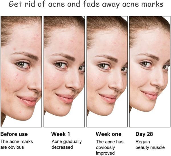 Aichun Beauty Whitening & Anti-Acne Serum | Aloe Vera & Salicylic Acid | 30ml Skin Brightening Formula