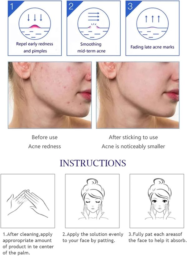 Aichun Beauty Whitening & Anti-Acne Serum | Aloe Vera & Salicylic Acid | 30ml Skin Brightening Formula